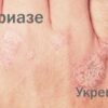 Мумиё при псориазе